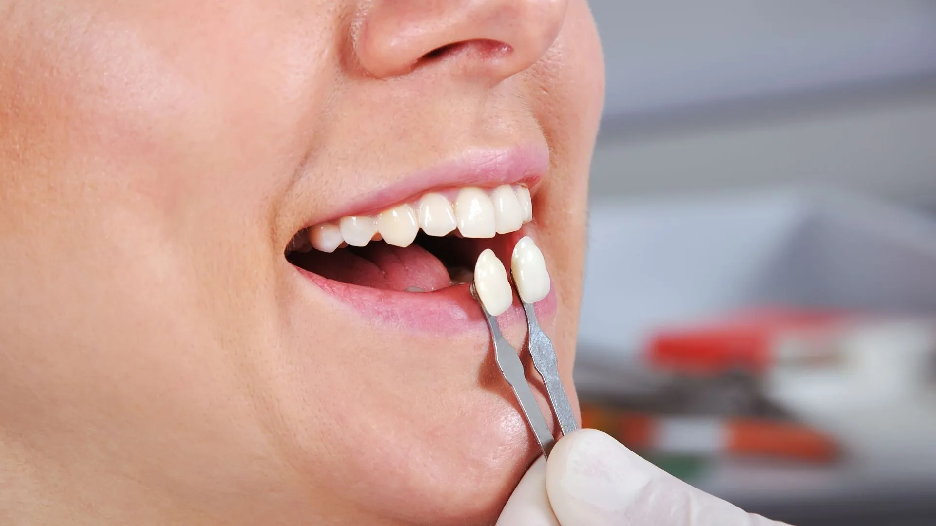 Composite veneers in Smeaton Grange in SmileSavers