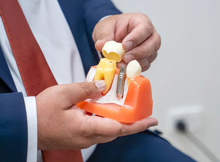 Dental Crowns & Bridges in Narellan, Campbelltown