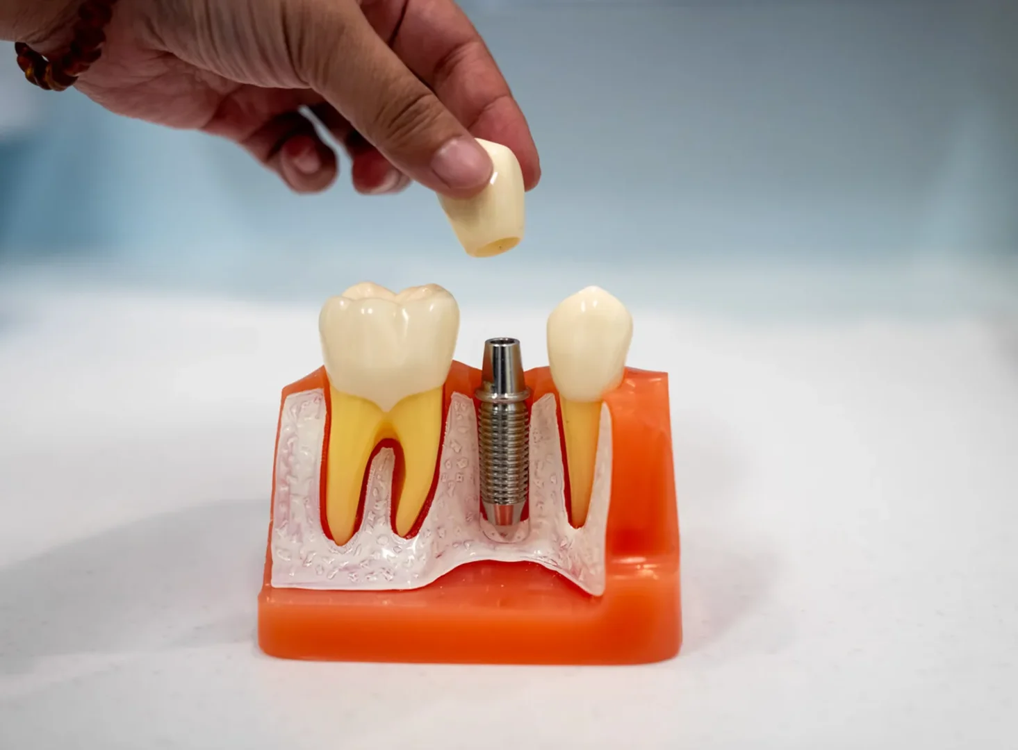 Dental Implants in Narellan, Campbelltown
