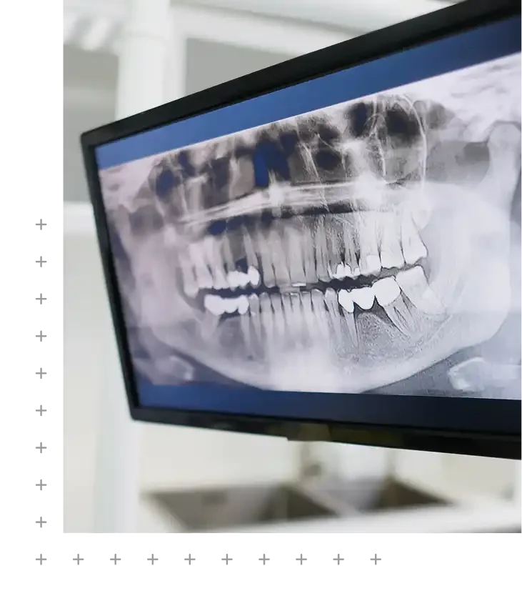 OPG (Panoramic X-Ray) in Narellan & Campbelltown in SmileSavers