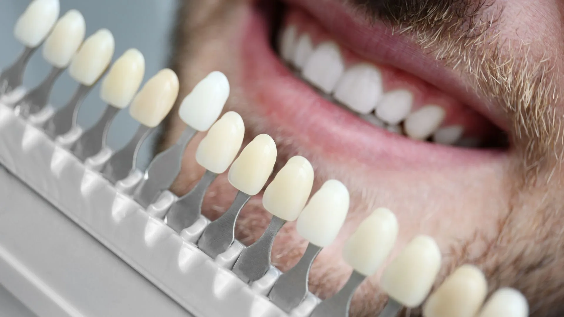 Porcelain Veneers in Glen Alpine in SmileSavers