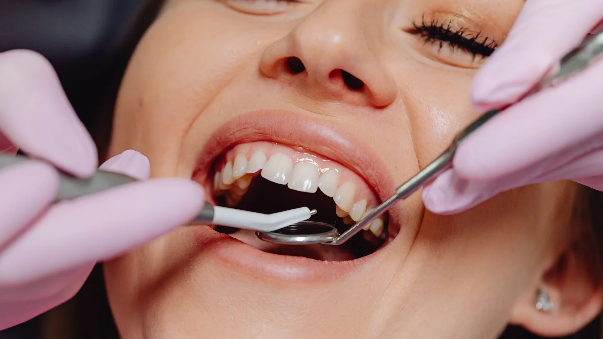 dental crowns and porcelain veneers in Narellan in SmileSavers